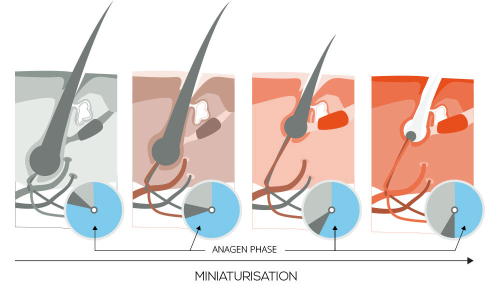 Miniaturisation - Anagen Phase