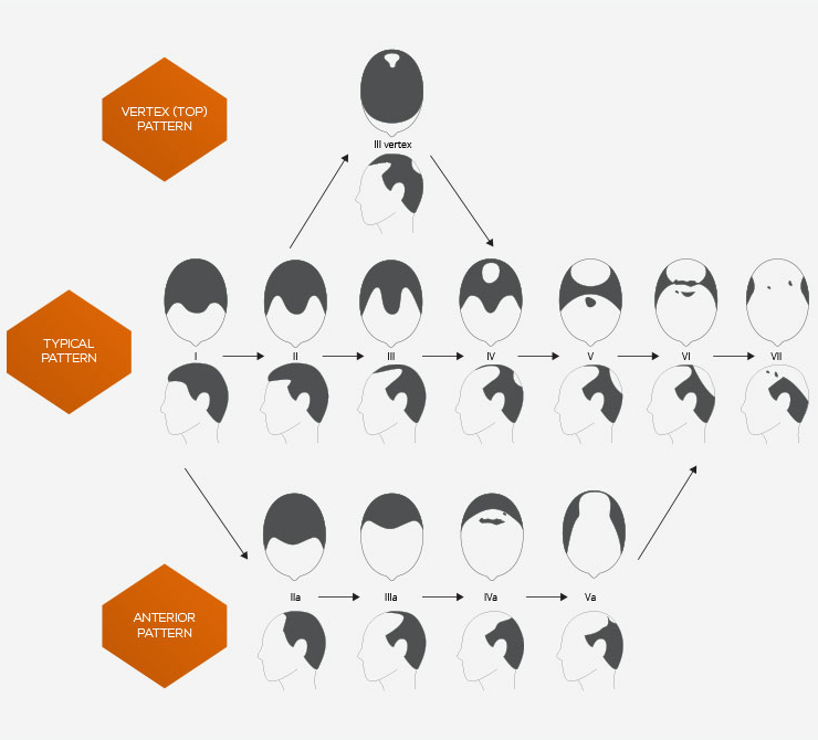 The Norwood Scale of male pattern baldness