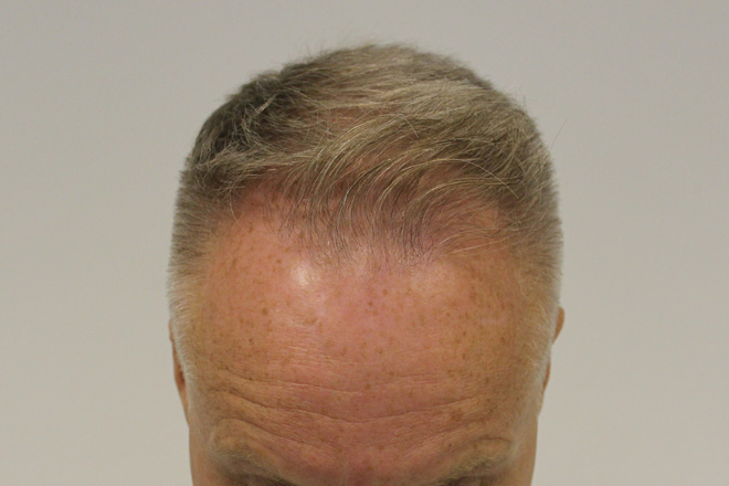 front-tilt-after.jpg