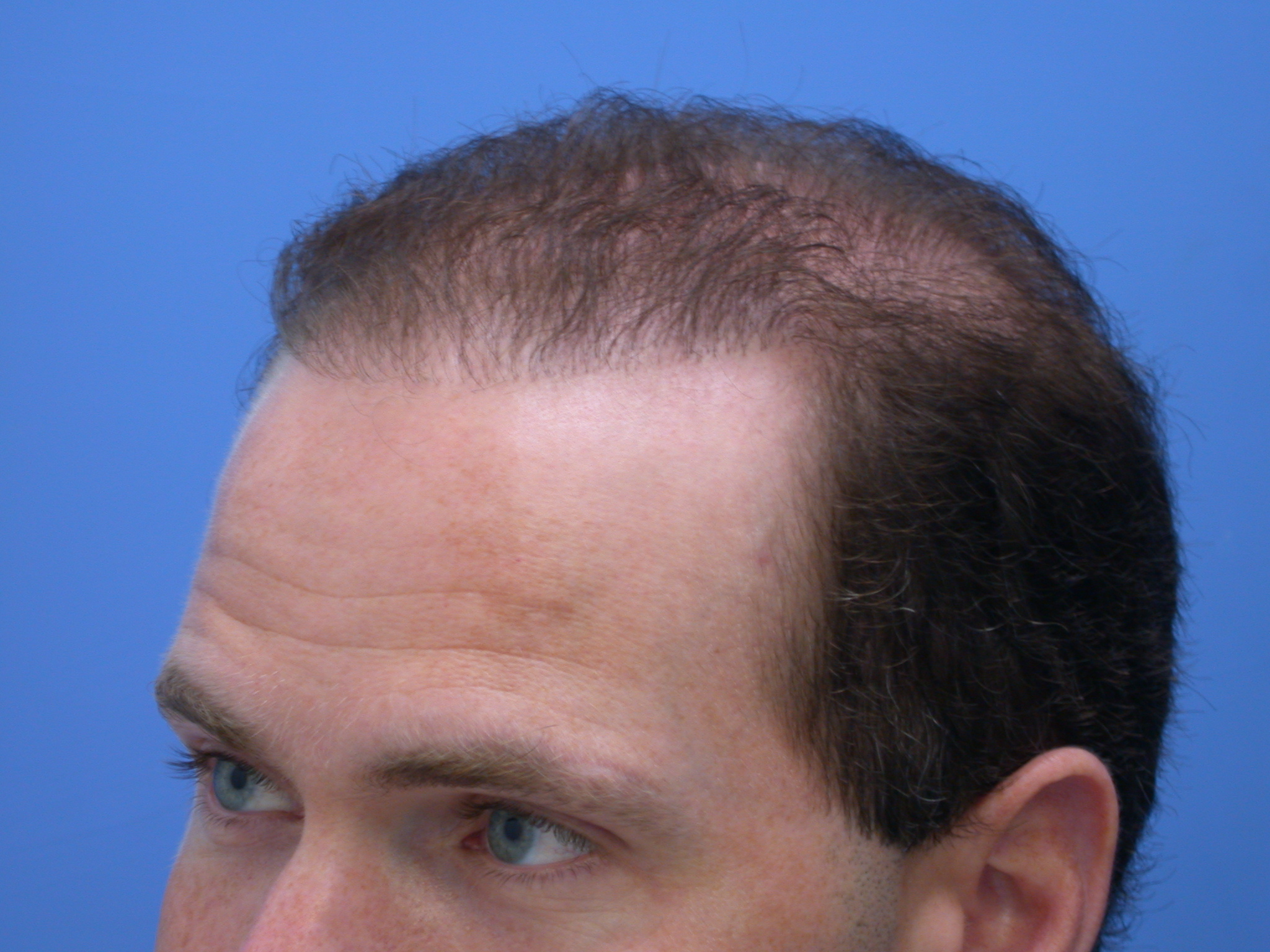 David Anderson 'Garageland' hair transplant repair