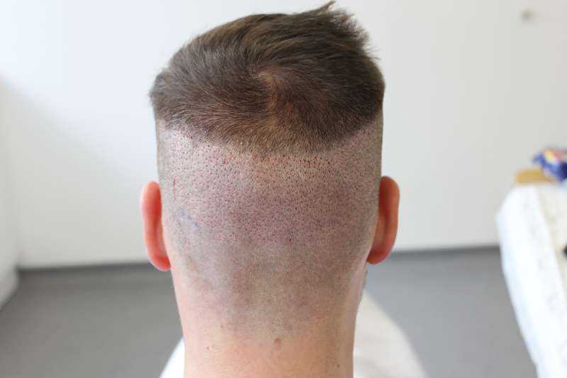 A man's head showing new growth from transplanted grafts