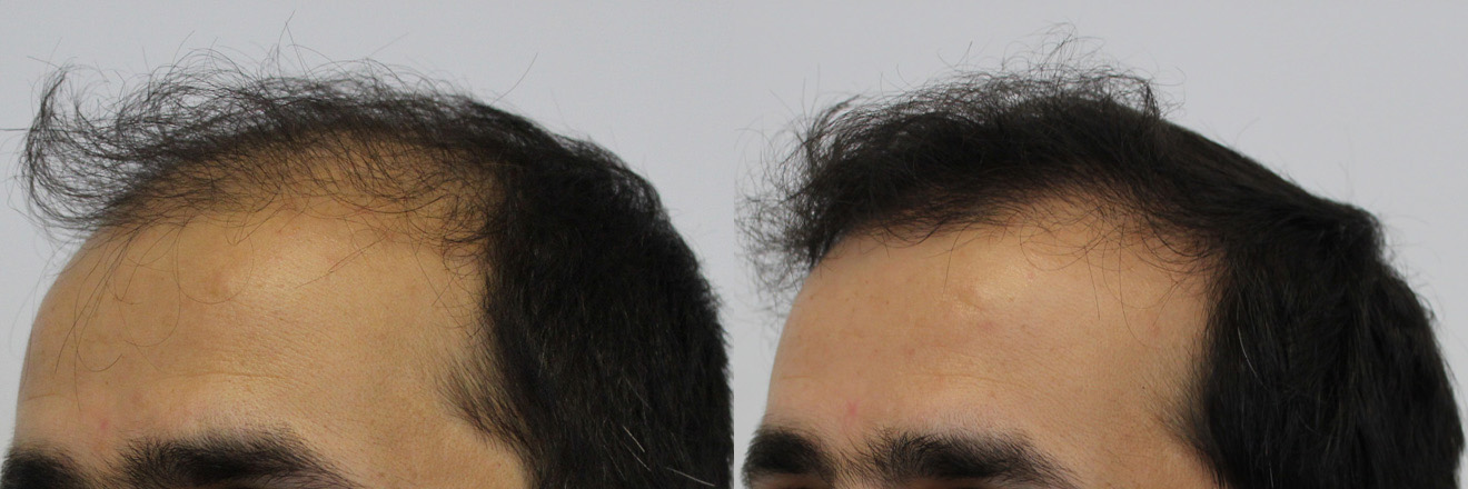 Left-tilt-before-and-after.jpg