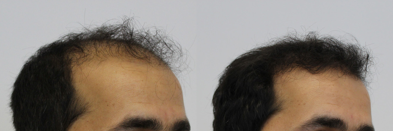Right-tilt-before-and-after.jpg