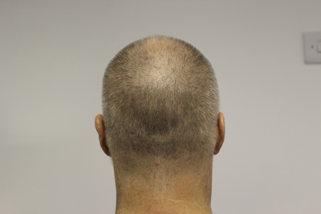 back-before.jpg