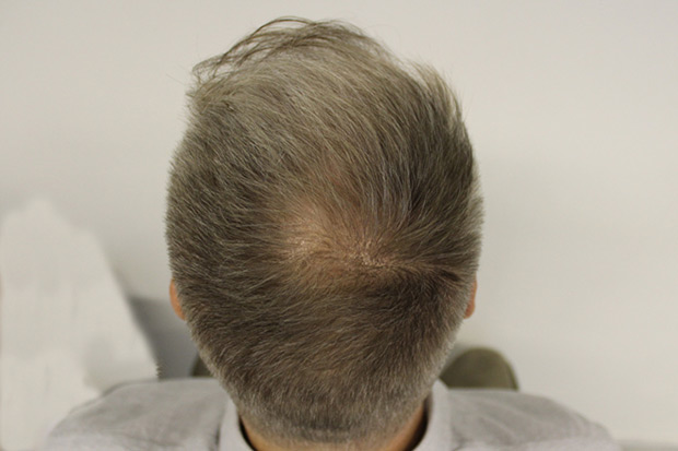 crown-after2.jpg