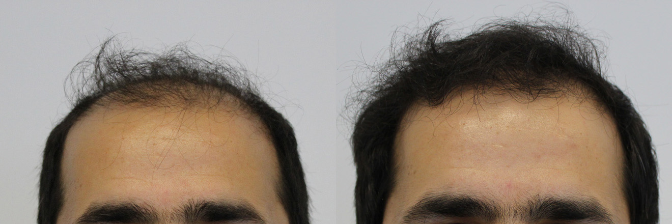 front-before-and-after.jpg