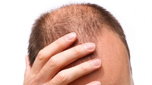 A man seeking advice on managing hair loss at a young age from The Maitland Clinic