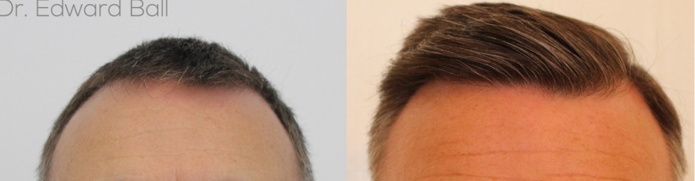 New FUE result by Dr Edward Ball