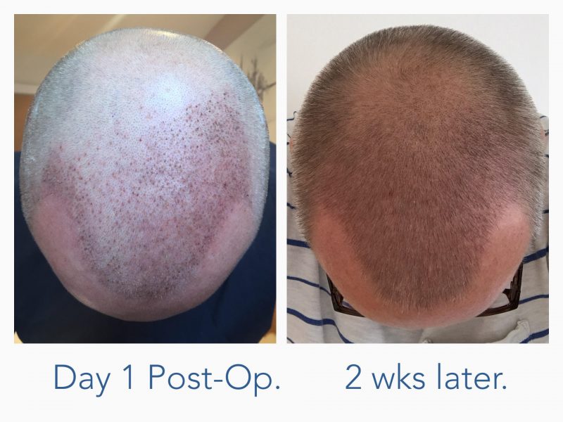 How soon can I return to work after FUE? A Post Op FUE recovery blog