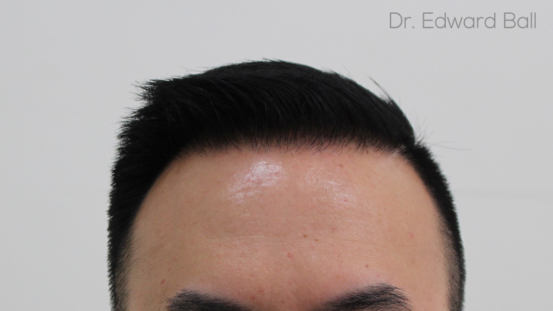 Dr-Ball-FUE-result-after-1.jpg