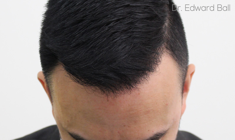 Dr-Ball-FUE-result-after-2.jpg