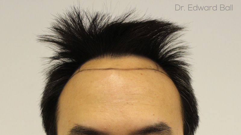 Dr-Ball-FUE-result-before-1.jpg