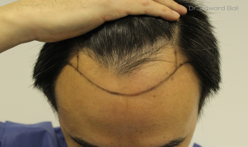 Dr-Ball-FUE-result-before-2.jpg