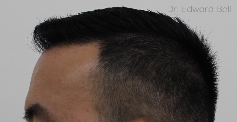 Dr-Ball-fue-result-after-3.jpg