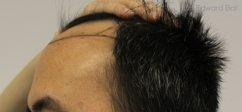 Dr-Ball-fue-result-before-3.jpg