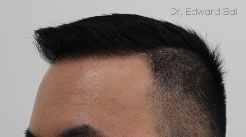 Dr-Edward-Ball-FUE-result-after-4.jpg