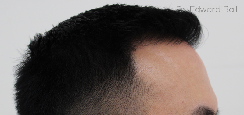 Dr-Edward-Ball-FUE-result-after-5.jpg