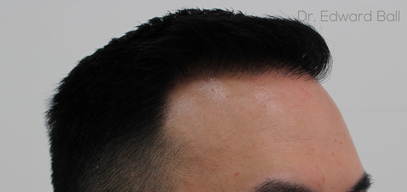 Dr-Edward-Ball-FUE-result-after-6.jpg