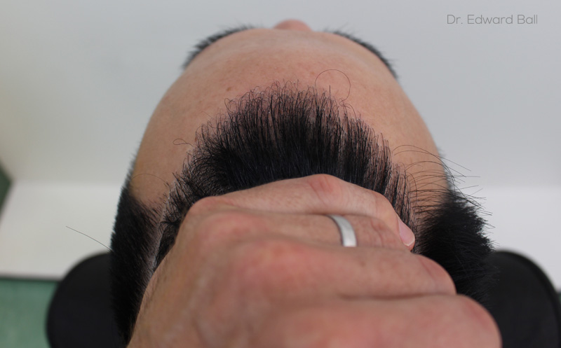 Dr-Edward-Ball-FUE-result-after-8.jpg