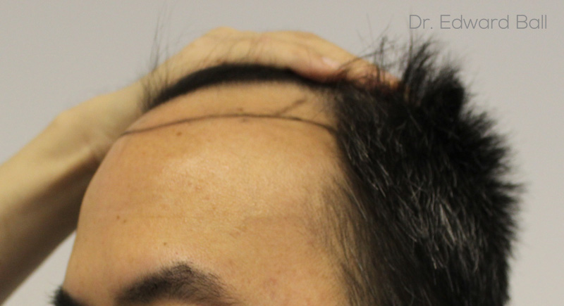 Dr-Edward-Ball-FUE-result-before-4.jpg