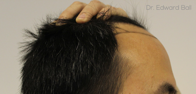 Dr-Edward-Ball-FUE-result-before-5.jpg