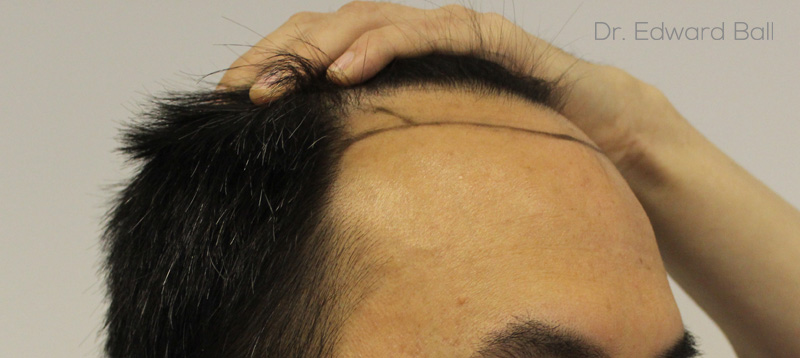 Dr-Edward-Ball-FUE-result-before-6.jpg