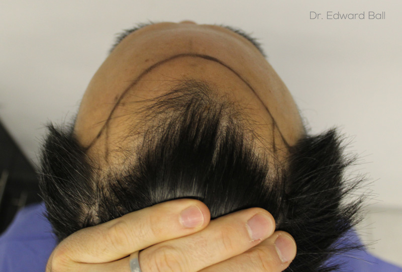 Dr-Edward-Ball-FUE-result-before-8.jpg