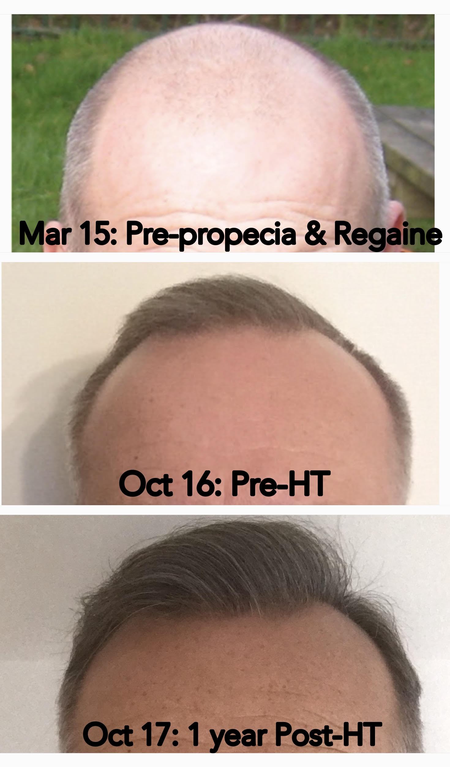 Patient's hair pre- and post-transplant, one year later