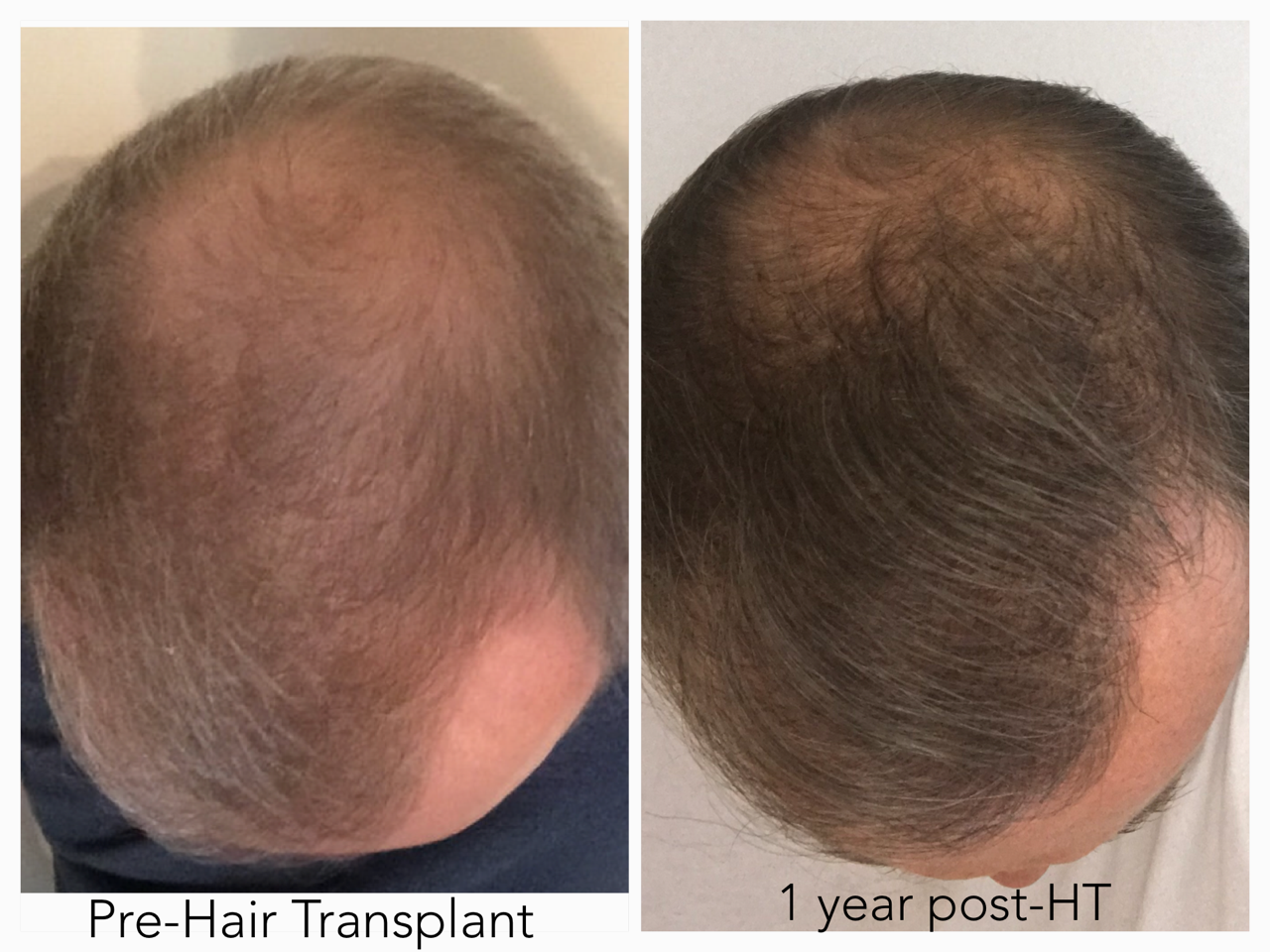 A patient's scalp two weeks post-hair transplant by The Maitland Clinic