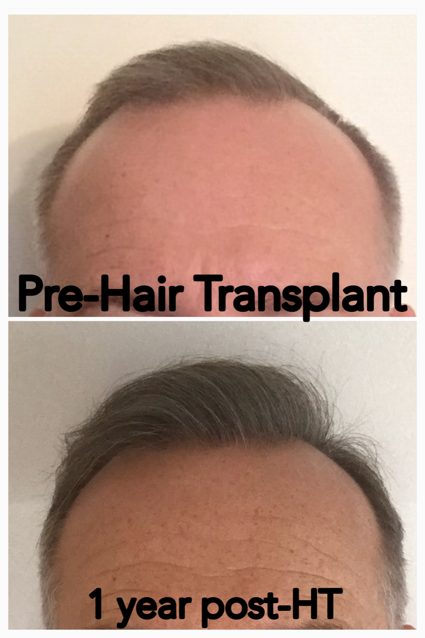 Patient's hair pre- and post-transplant, one year later