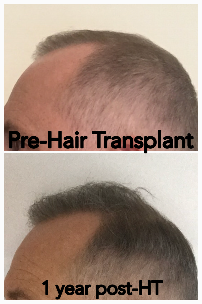 Patient's hair pre- and post-transplant, one year later