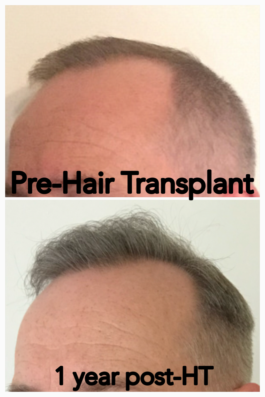 Patient's hair pre- and post-transplant, one year later