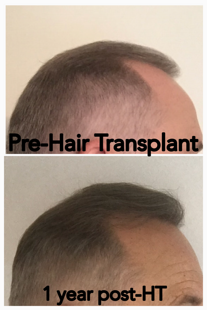 Patient's hair pre- and post-transplant, one year later