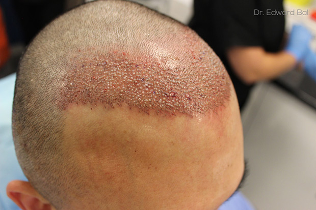Dr-Edward-Ball-FUE-placement-2.jpg