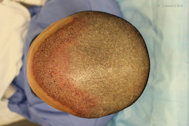 Dr-Edward-Ball-FUE-placement-photo-1.jpg