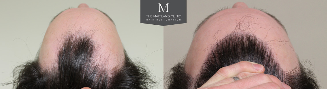 New FUE Patient Blog- 2217 Grafts Hairline Restoration