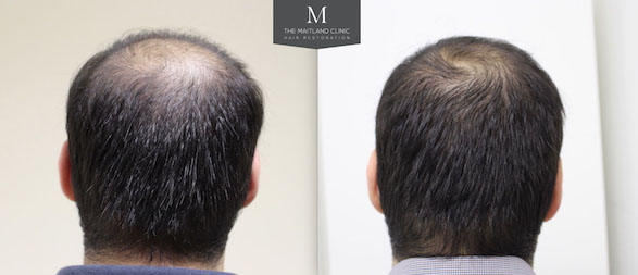 How many PRP treatments are needed for hair growth