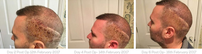 is fue hair transplant painful