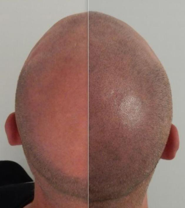 Learn about scalp trichopigmentation (STP) & scalp micropigmentation (SMP) – by Janna Shafer