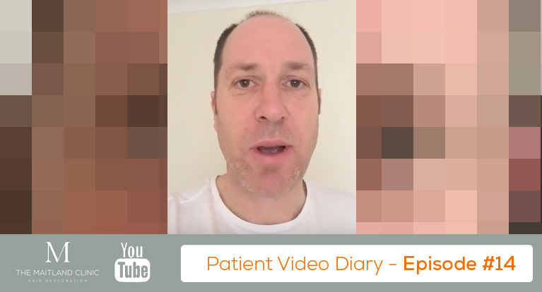 1 Month After Hair Transplant Surgery - Video Diary Episode 14