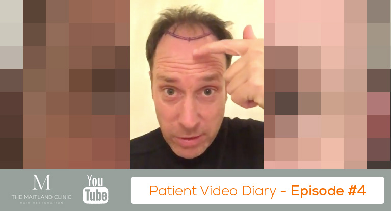 FUT Hair Transplant Review – The Day Before Surgery – Video Diary #4