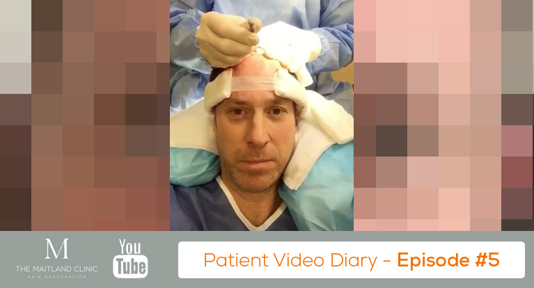 FUT Hair Transplant Review – The Start of Surgery (3,943 Grafts) – Video Diary #5