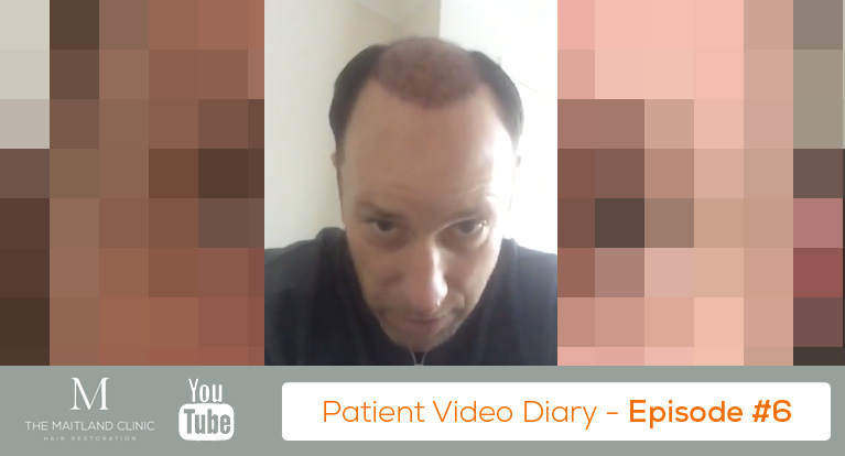 FUT Hair Transplant Review – Day 1 Results 24 Hours After Surgery – Video Diary #6