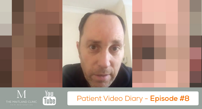 FUT Hair Transplant Results After 2 Days - Real Life Patient Video Diary