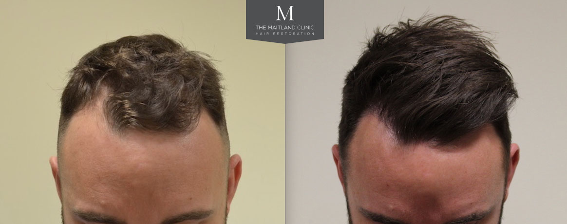 FUE Hairline Restoration 1502 Grafts 10 Months Post Op