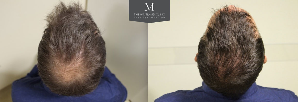 FUE Hair Transplant 1349 Grafts Into Crown