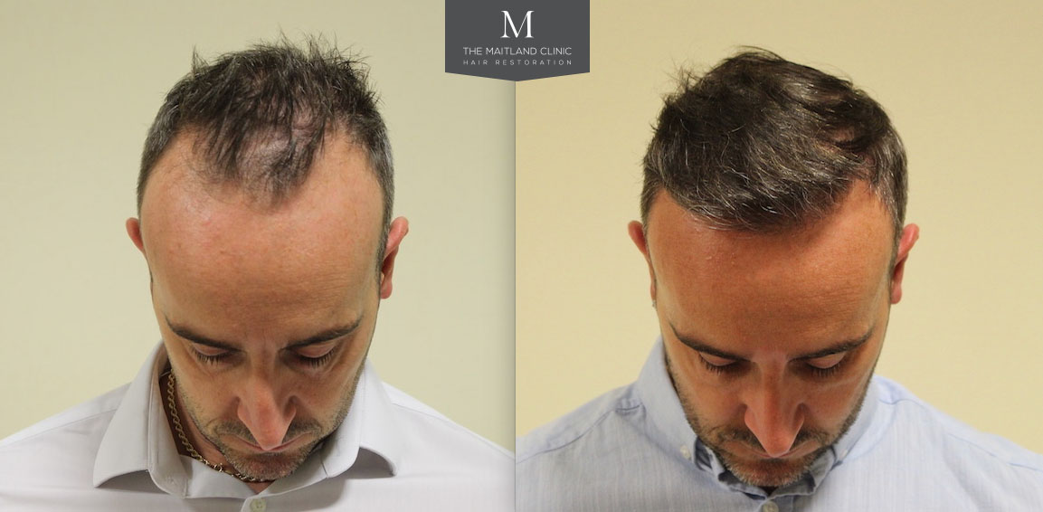 FUE Hair Transplant 2162 Grafts Hairline Lowering 8 Months Post Op