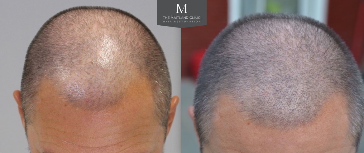 FUE hair restoration before-and-after results, showing enhanced hair density