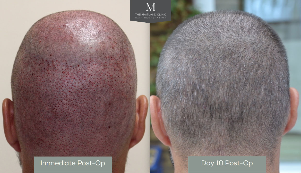 FUE Hair Transplant Recovery- Another How Soon Will I Look Normal After  Surgery Blog - The Maitland Clinic