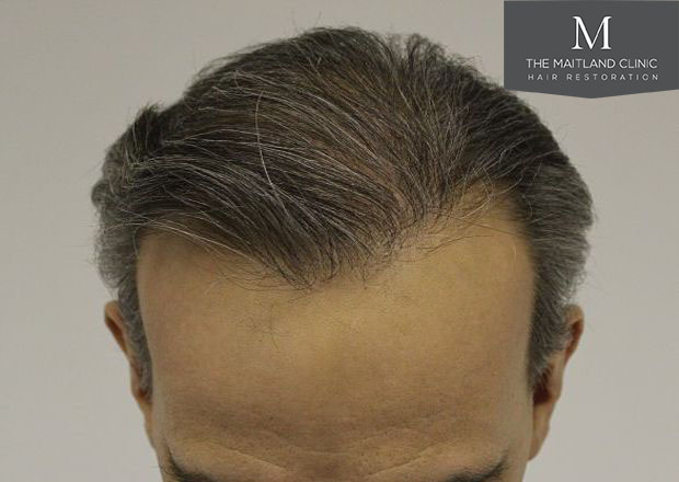 4010 grafts by FUT